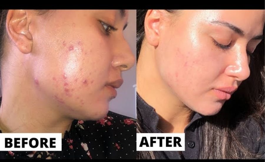 tretinoin before after
