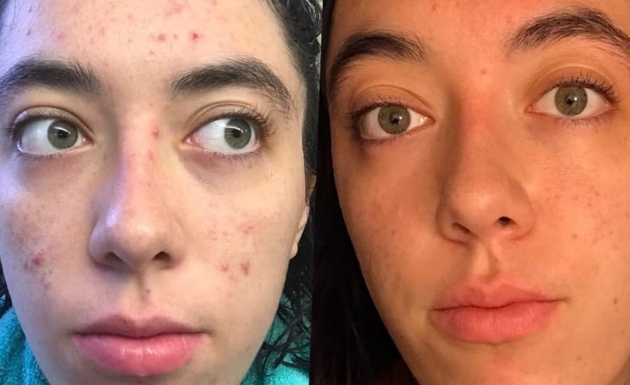tretinoin before after