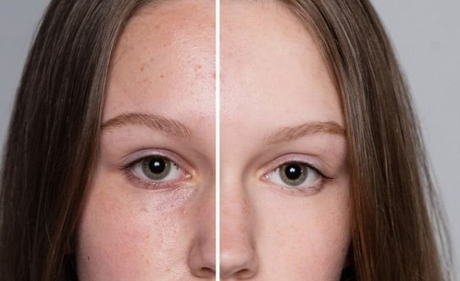 tretinoin before after