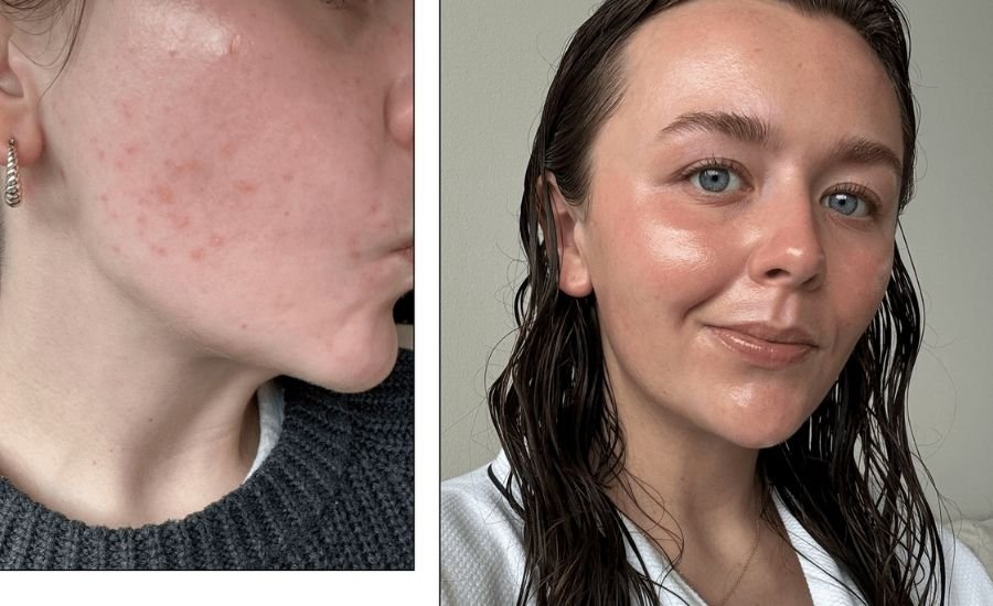 tretinoin before after