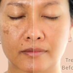 Tretinoin before after